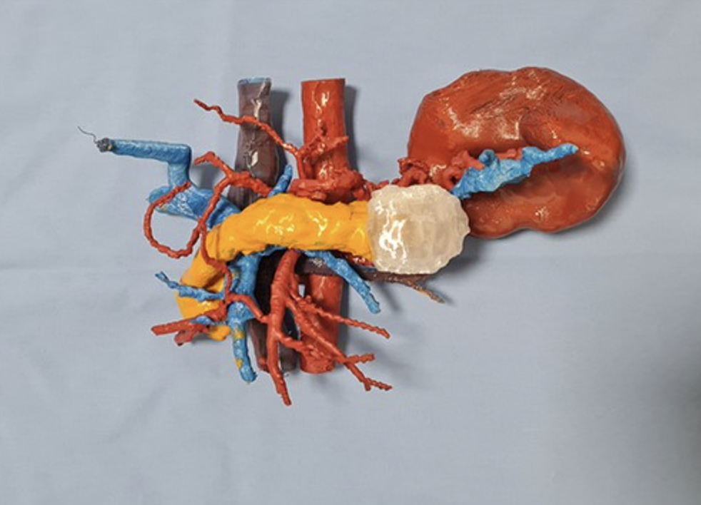 Enhancing surgical planning of distal splenopancreatectomy through 3D printed models: a case report